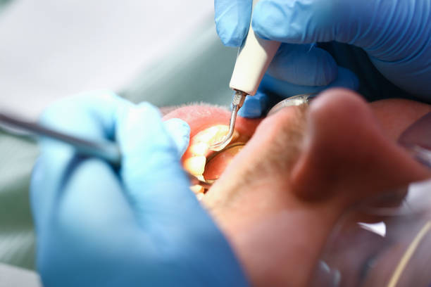 Best Emergency Treatment for Dental Infections or Abscesses in Kenton, OH