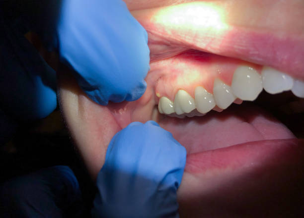Best Emergency Wisdom Teeth Removal in Kenton, OH