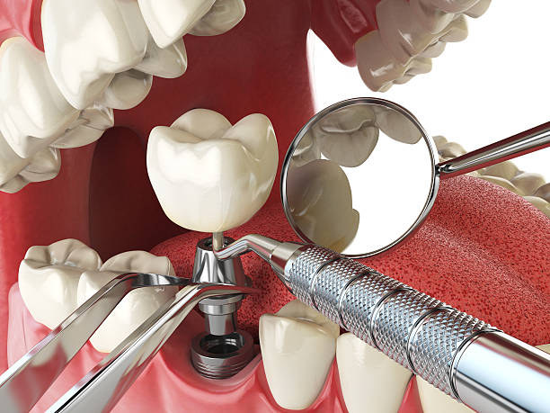 Best Emergency Root Canal Treatment in Kenton, OH